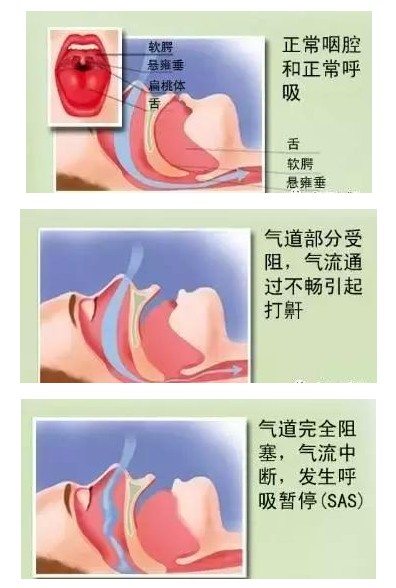 呼吸機可以完全治愈睡眠呼吸暫停嗎？